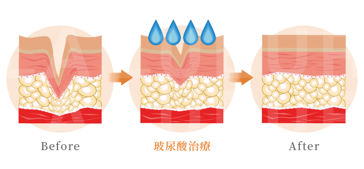 Belotero保柔緹