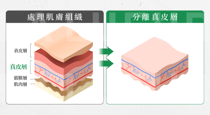 MegaFill異體真皮粉