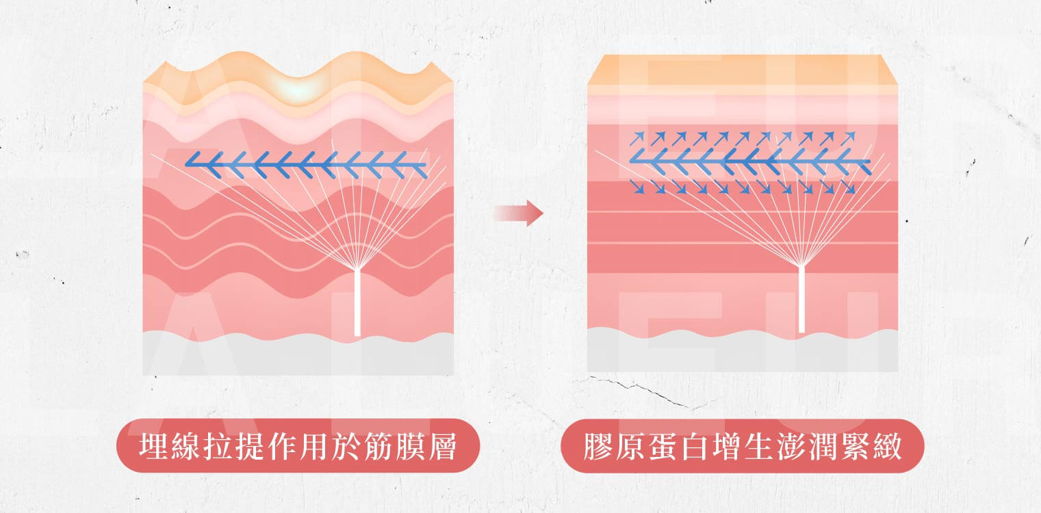 V-Loc玫瑰線
