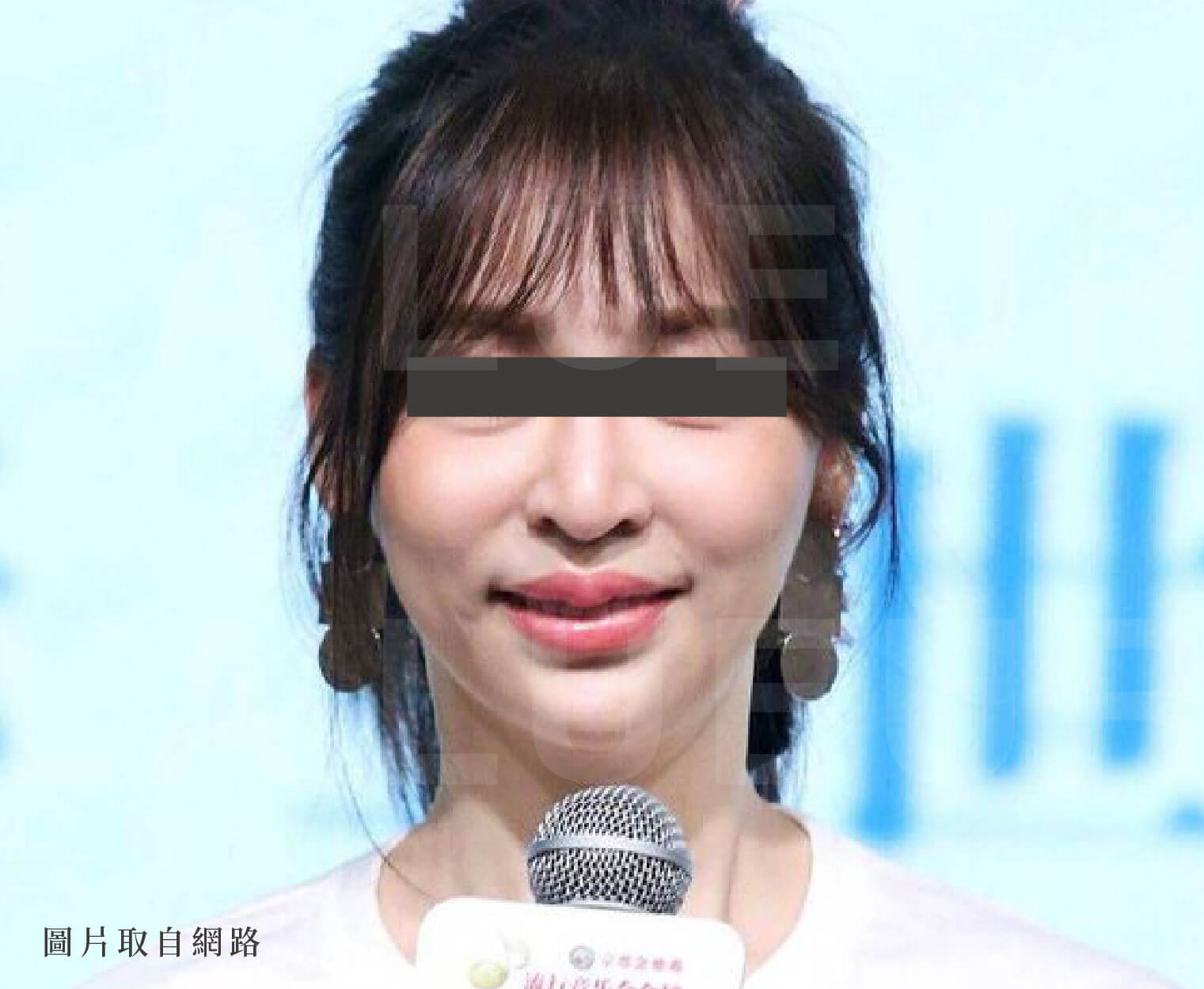 精選療程-臉頰凹陷鬆垮垂
