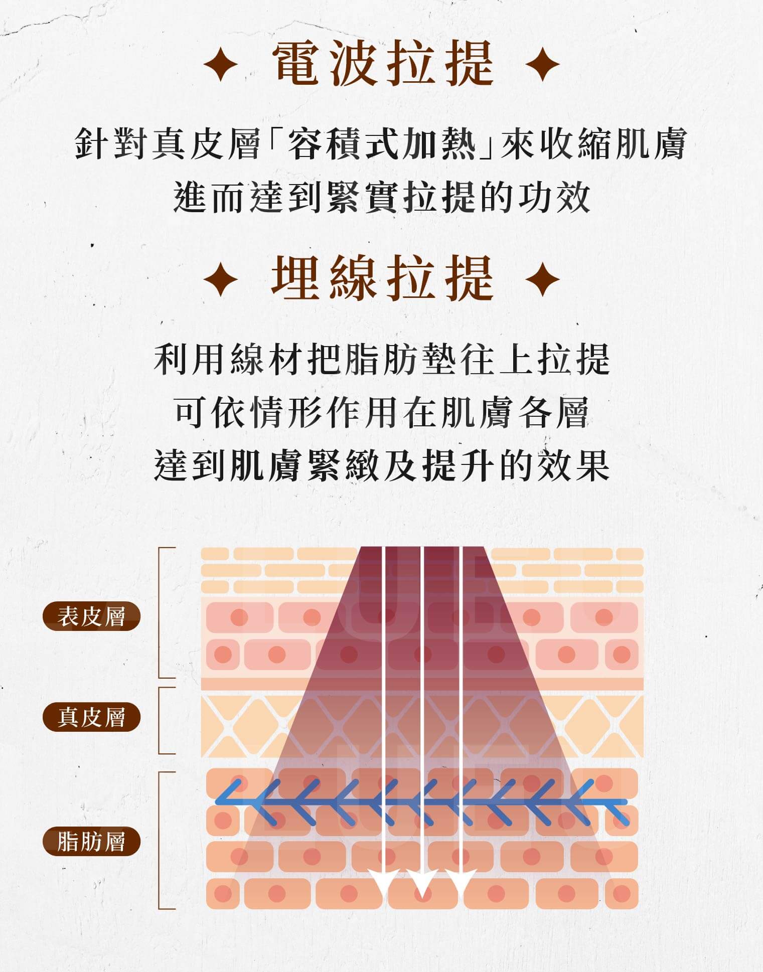 貴婦線性拉提-電波拉提-埋線拉提
