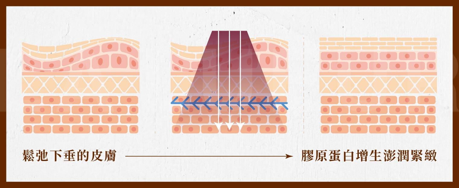 貴婦線性拉提-電波拉提-埋線拉提