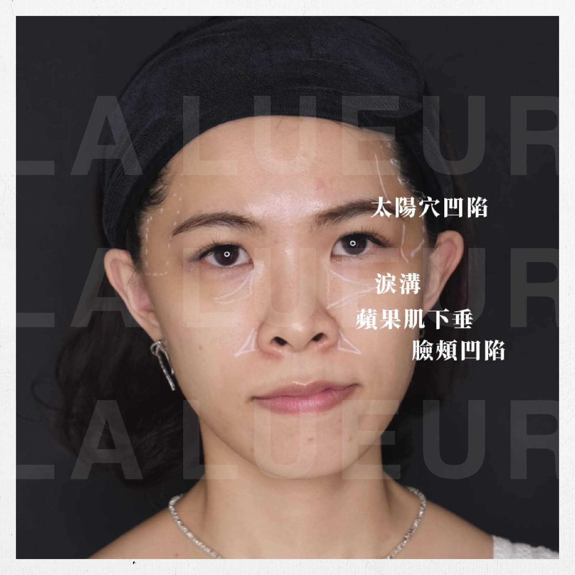 見證案例-6D輪廓固定法-小孟