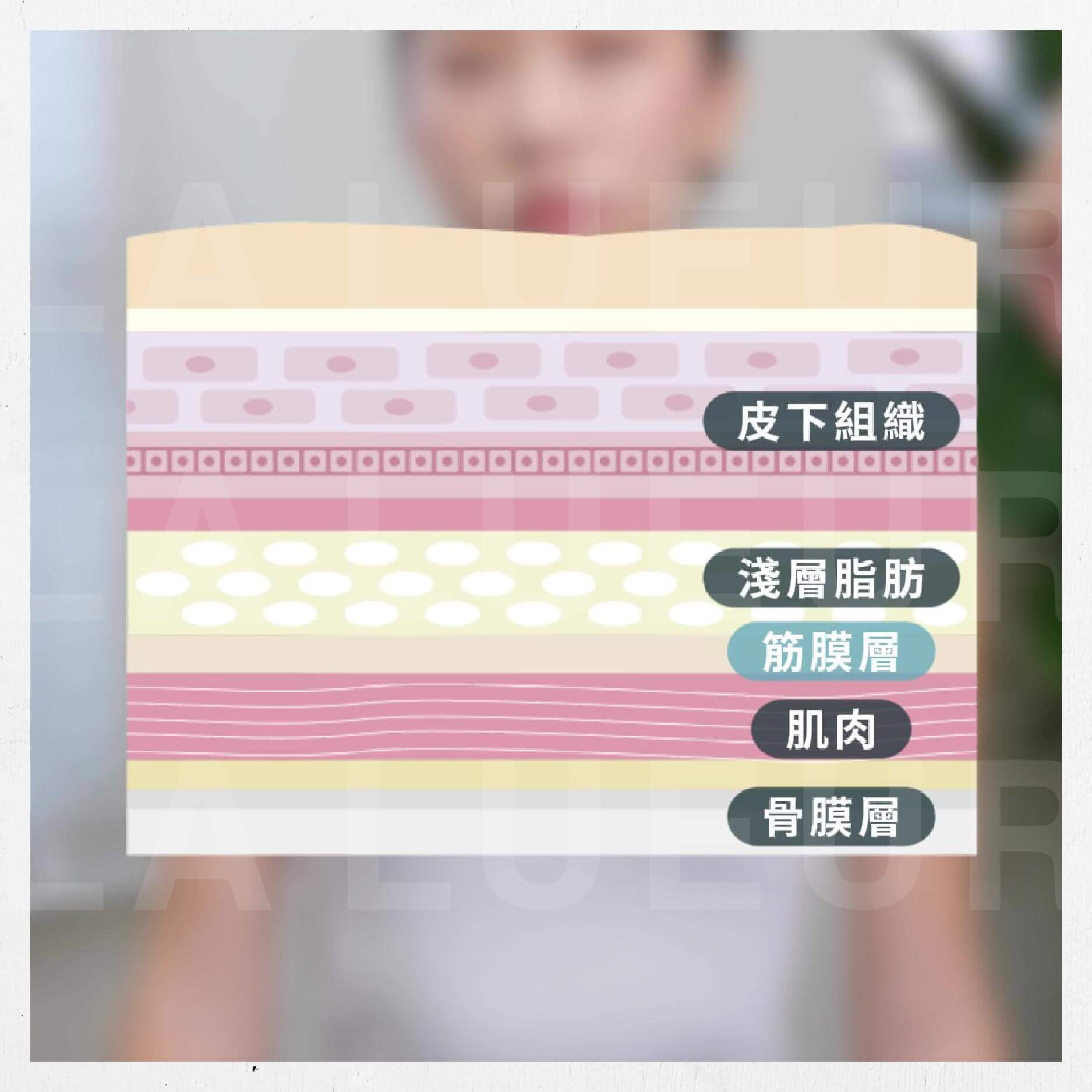 見證案例-6D輪廓固定法-小瑜