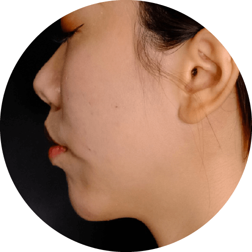 見證案例-6D輪廓固定法-小瑜