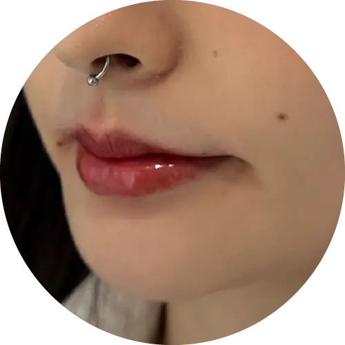 見證案例-三點式嘟嘟唇-Fiona