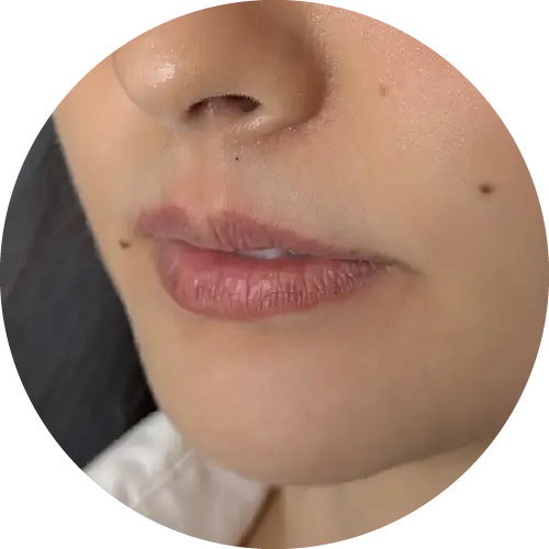 見證案例-三點式嘟嘟唇-Fiona