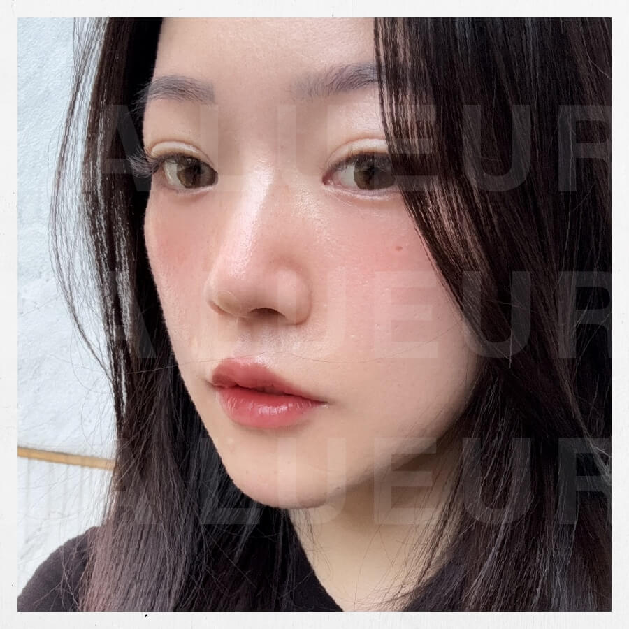 見證案例-三點式嘟嘟唇