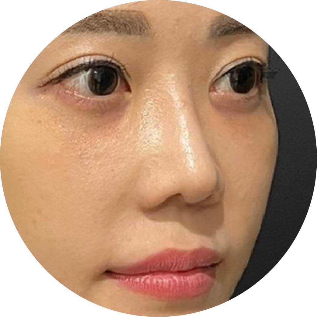 三點式嘟嘟唇+膠原蛋白熊貓針