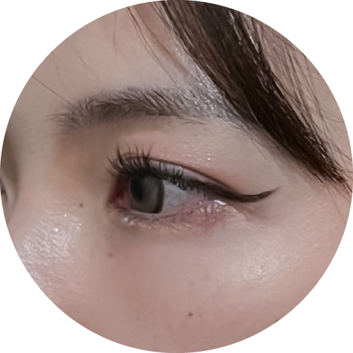 見證案例-淚溝黑眼圈-CONNIE