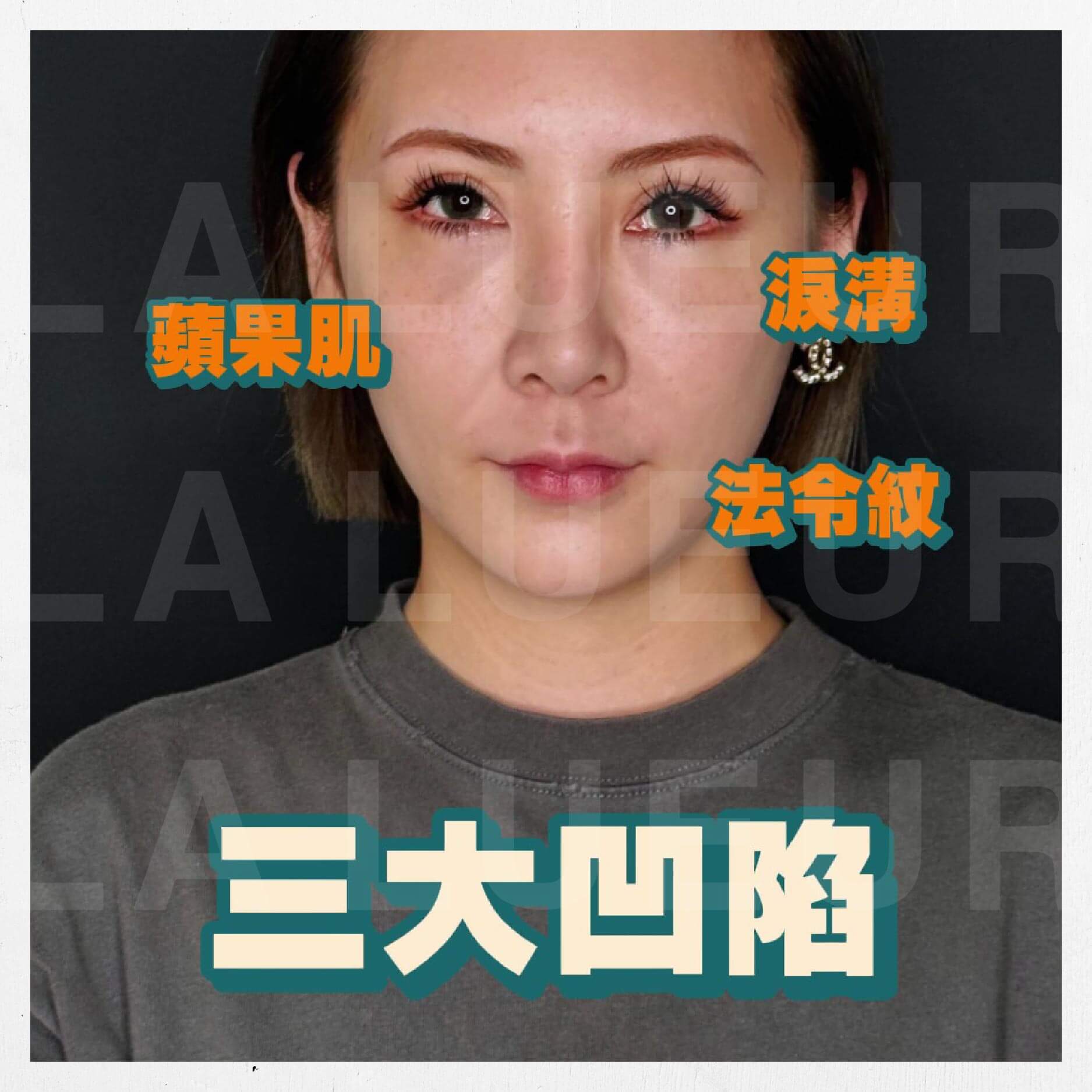 見證案例-玻尿酸蘋果肌-蘇蘇