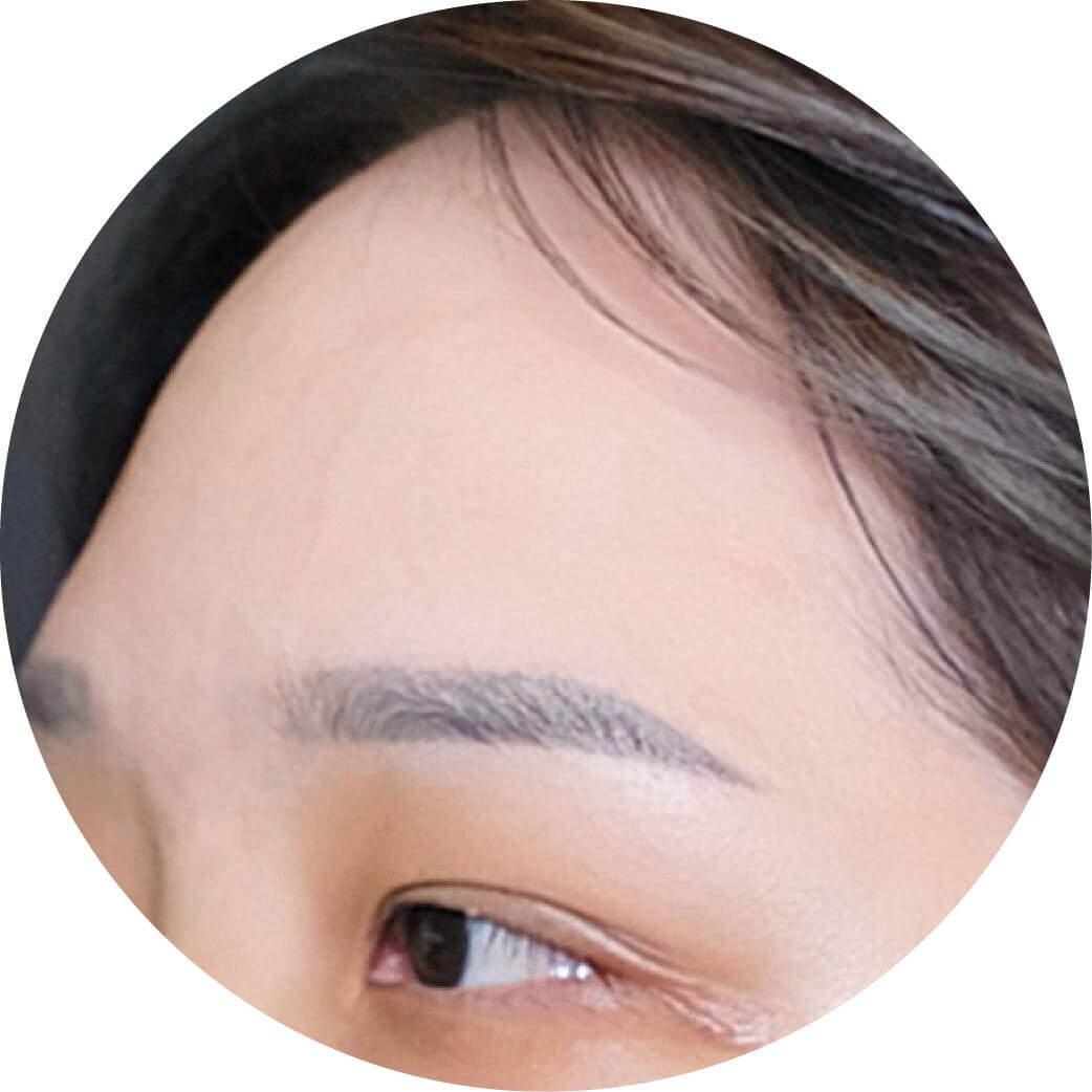 見證案例-皮秒雷射