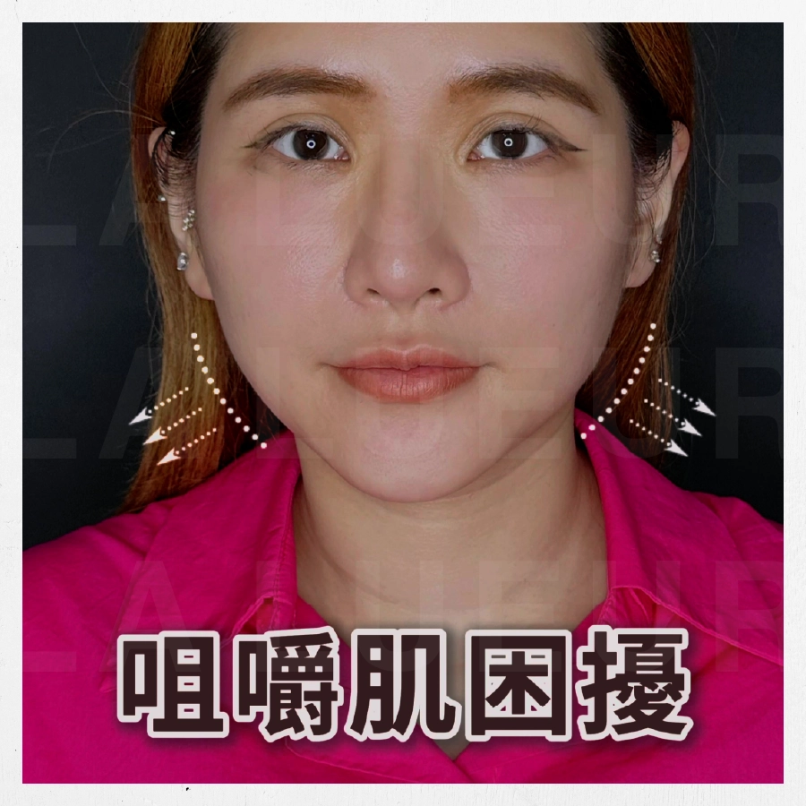 見證案例-肉毒小臉--Paris