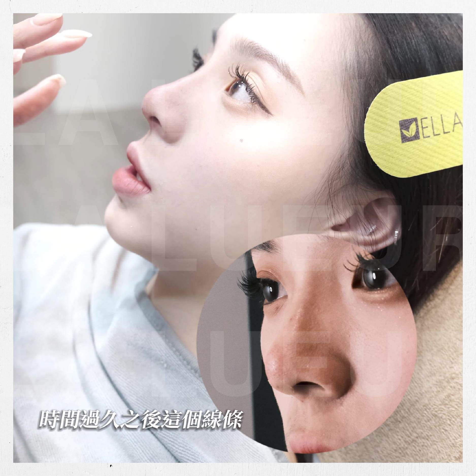 韓式精雕隆鼻術