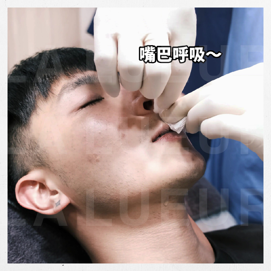 見證案例-韓式精雕隆鼻術-WEIWEI