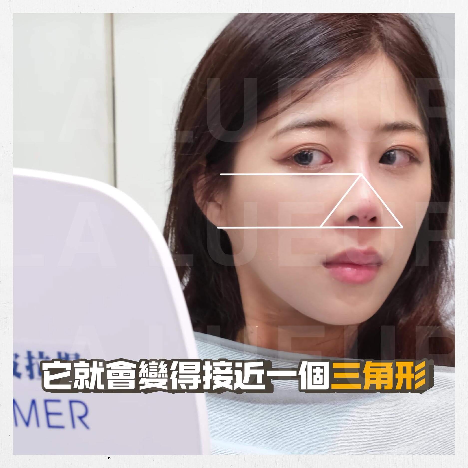 見證案例-韓式精雕隆鼻術-小潔