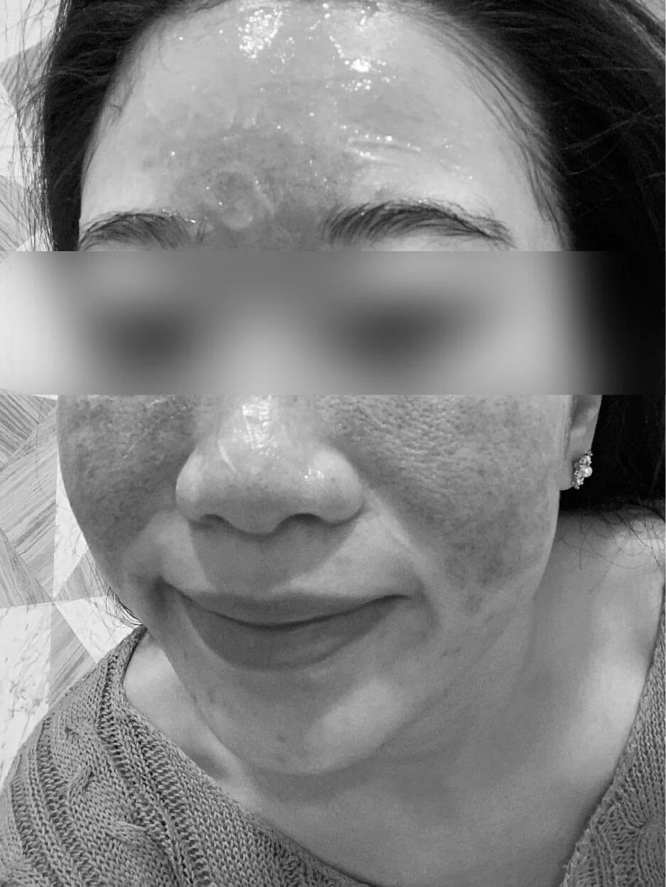 醫師專欄-皮秒打到出血