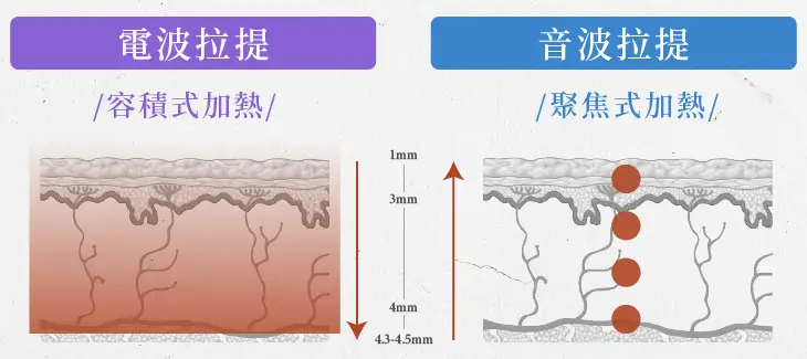 醫師專欄-電波拉皮與音波拉提差別一次看